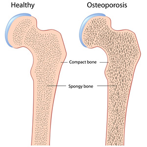 Dr. J Veldman - Bone Densitomerty